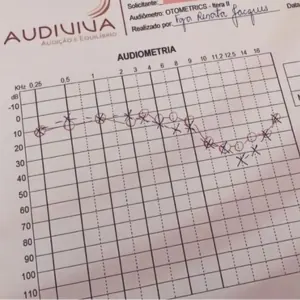 Audiograma usado na avaliação do zumbido